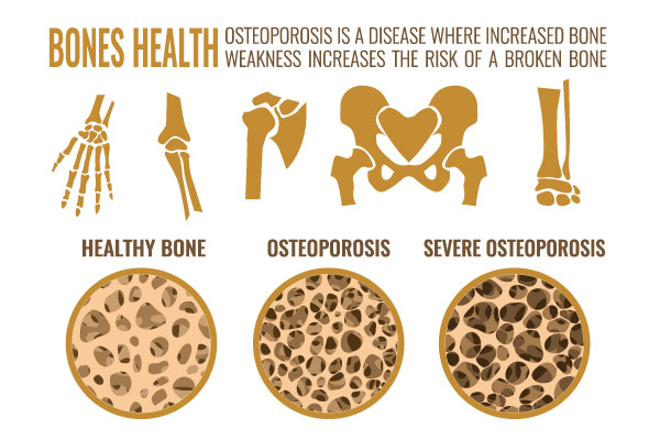 Bone-health-giotto-project